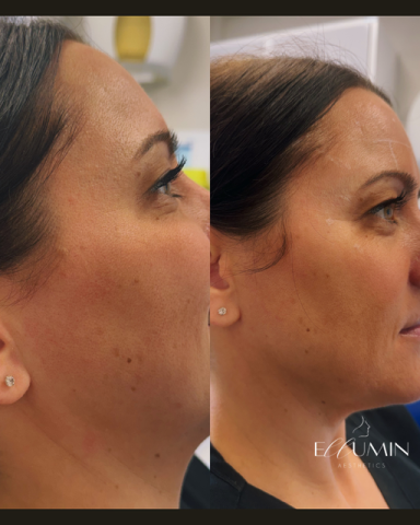 Anti-wrinkle Treatment