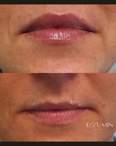 Anti-wrinkle Lip Enhancement