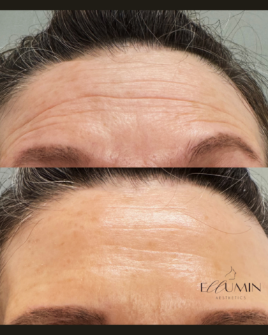 Anti-wrinkle Treatment
