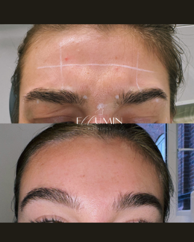 Anti-wrinkle Treatment