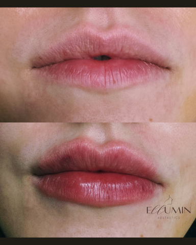 Lip Enhancement