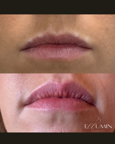Anti-wrinkle Lip Enhancement